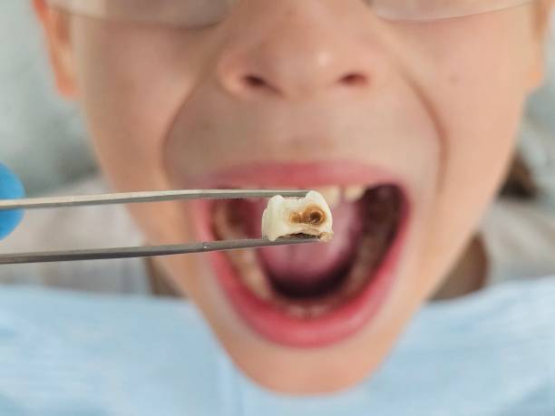 Best Emergency Broken Tooth Repair in Neffs, OH